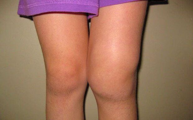 otečeni zglob koljena zbog osteoartritisa