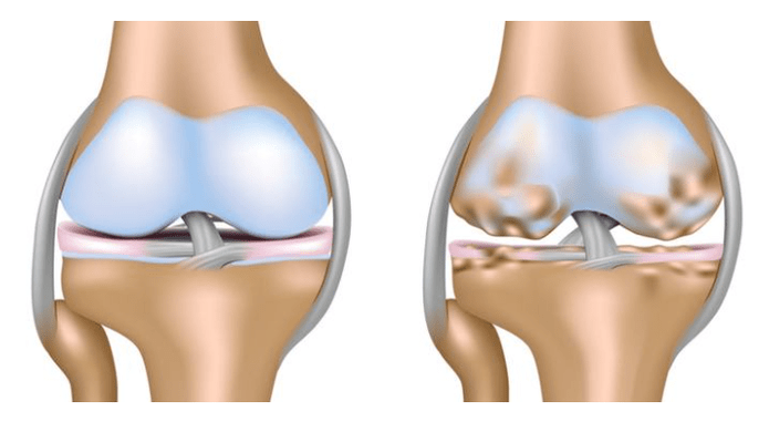 zdrava hrskavica i oštećenje kolenskog zgloba sa artrozom