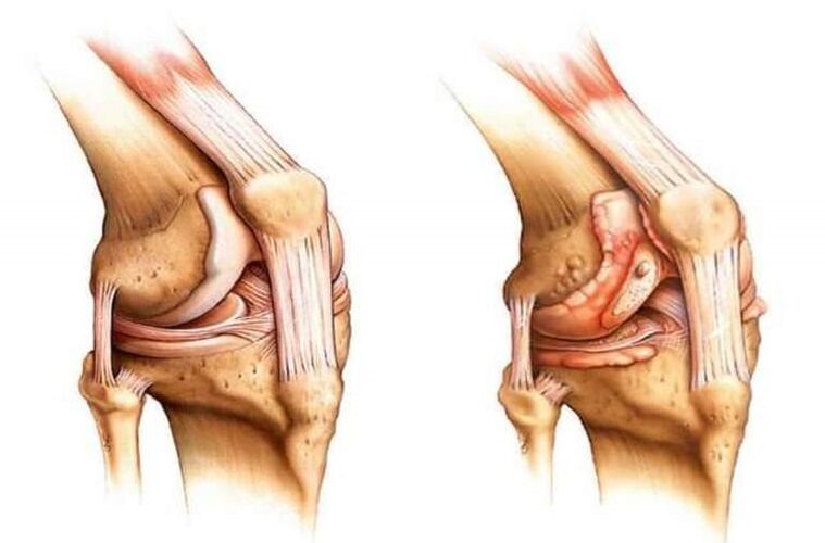 zdravo koleno i artroza kolenskog zgloba