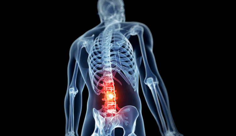 lezija lumbalne kičme u osteohondrozi
