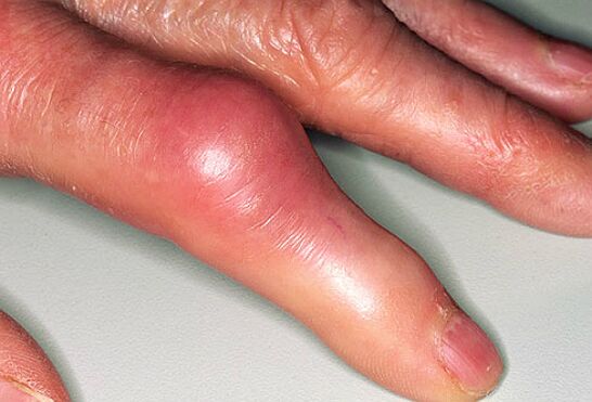 Giht je praćen oštrim bolom u prstima i oticanjem zglobova. 