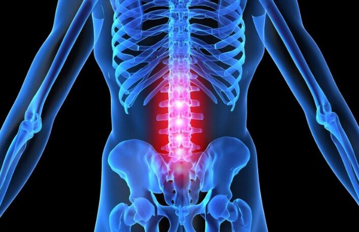 Osteohondroza lumbalne regije